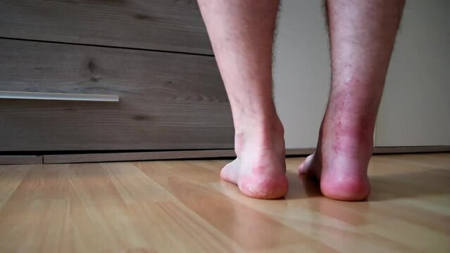 Man with pain from achilles tendon rupture