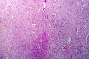 Neurofibromatosis, light micrograph, photo under microscope