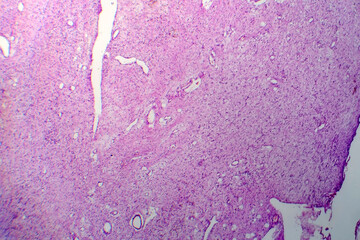 Neurofibromatosis, light micrograph, photo under microscope