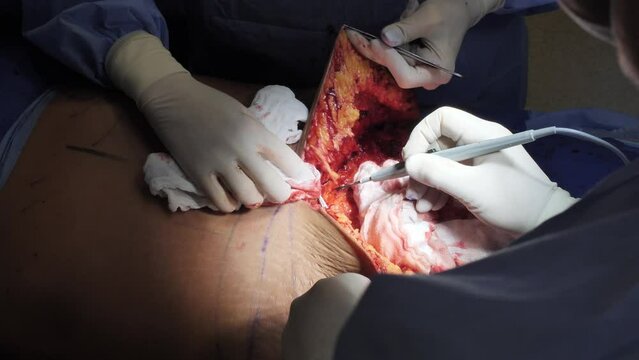 Surgical operation abdominoplasty. Close-up of the patient on the operating table, surgical removal of fat tissue from the abdomen.