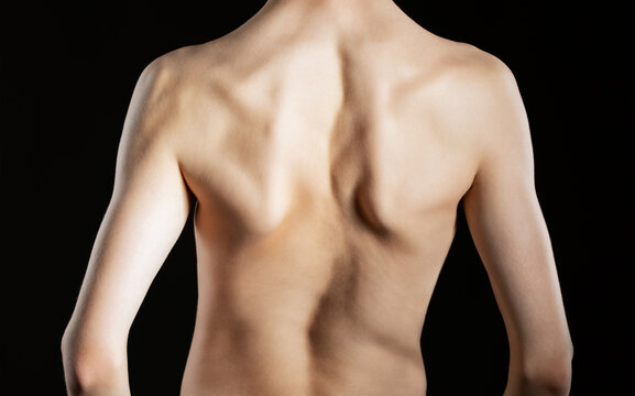 A young man with a severe curvature of the spine on a black background. Scoliosis treatment.