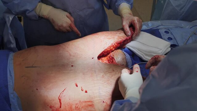 Surgical operation abdominoplasty. Close-up of the patient on the operating table, surgical removal of fat tissue from the abdomen.