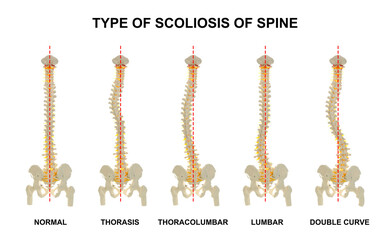 Medical poster demonstrating types of scoliosis on white background. Illustration of healthy and...