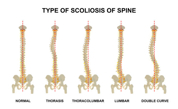 Medical poster demonstrating types of scoliosis on white background. Illustration of healthy and diseased spine