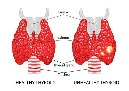 Illustration of healthy and diseased thyroid on white background