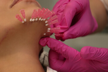 Close up face of thread lifting procedure. Professional cosmetologist in pink medical gloves inserting needles in chin scin. Anti-aging treatment and face lift in cosmetology clinic. Pretty woman fac