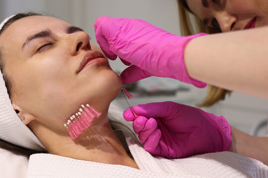 Close up face of thread lifting procedure. Professional cosmetologist in pink medical gloves inserting needles in chin scin. Anti-aging treatment and face lift in cosmetology clinic. Pretty woman fac