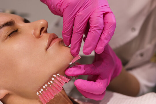 Close up face of thread lifting procedure. Professional cosmetologist in pink medical gloves inserting needles in chin scin. Anti-aging treatment and face lift in cosmetology clinic. Pretty woman fac