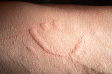 Fototapeta premium Smiling face hives. Hives spread when you scratch on the skin.