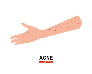 Acne on a female hand. Allergy treatment, skin problems concept. Caucasian female hand with acne on a white background in a flat design. Vector illustration.