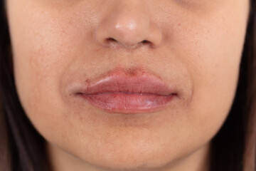 Obraz premium Close-up of female lips after augmentation. 