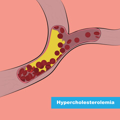 Familial hypercholesterolemia is a genetic disorder. It is caused by a defect on chromosome 19.