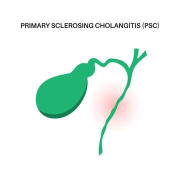Primary sclerosing cholangitis