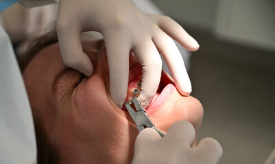 Woman having dental procedure in clinic. Concept of dentistry and orthodontic treatment.Close up of dentist hand using dental forceps while putting orthodontic braces on female patient teeth.