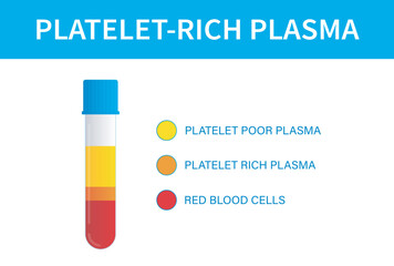 Test tube filled with blood after centrifugation of whole blood for PRP therapy. Platelet rich plasma Platelet poor plasma and Red blood cells. Preperation for Platelet-Rich Plasma (PRP) Injection.