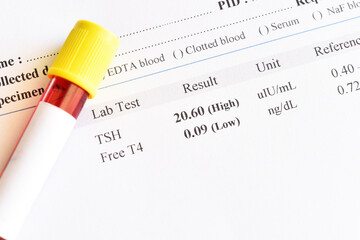 Hypothyroidism result with blood sample tube