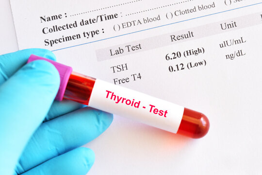 Hypothyroidism result with blood sample tube