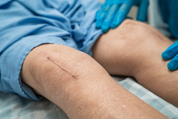 Asian senior or elderly old lady woman patient show her scars surgical total knee joint replacement...