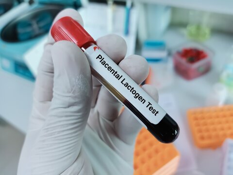 Biochemist of Scientist holds blood sample for Human placental lactogen (hPL) or Human chorionic somatomammotropin (HCS) test. Medical test tube in laboratory background.