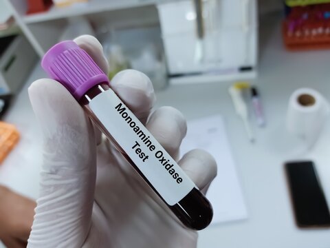 Biochemist of Scientist holds blood sample for Monoamine oxidase (MAO) test, a class of antidepressants drug. Medical test tube in laboratory background.