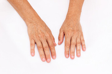 The hands of elderly woman with pigmented spots isolated on a white background. Age-related...