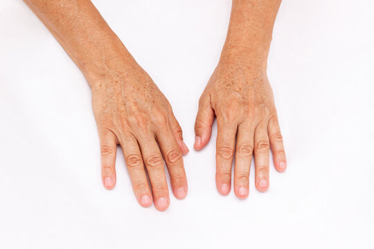 The hands of elderly woman with pigmented spots isolated on a white background. Age-related changes, flabby sagging skin, wrinkles and creases. Cosmetology and beauty concept