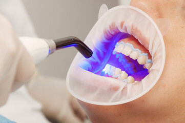 Close-up of a dentist using ultraviolet light for a tooth whitening treatment. No face,...