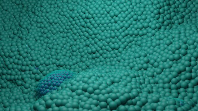 Prostate cancer is growing and attacked by t-cells