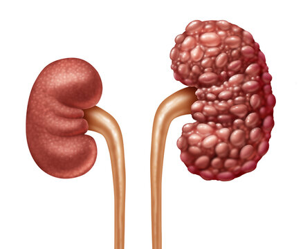 Chronic Kidney Disease or CKD as Human kidneys concept as one healthy and polycystic disease with cysts as anatomy of the urinary system on with a white background