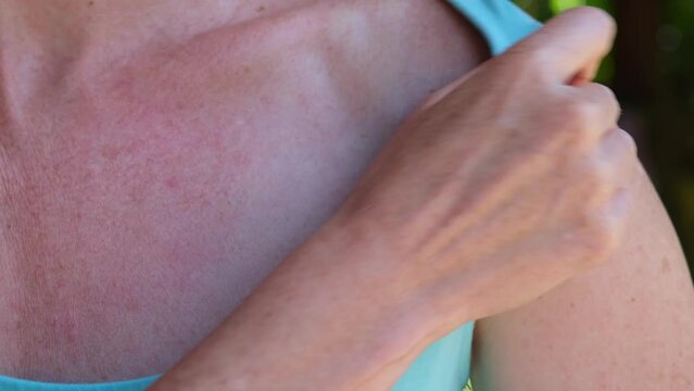A woman examines a skin rash on her chest and shoulders. Sun allergy. The skin has been damaged by the sun. Monkeypox