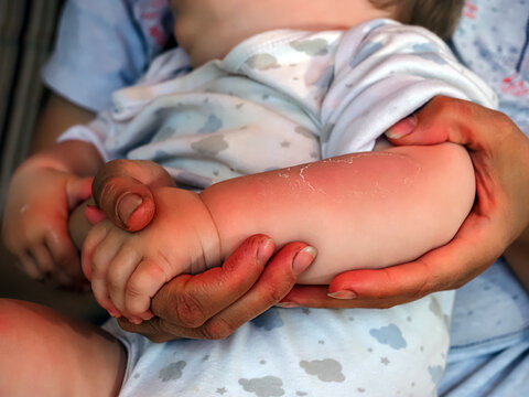 Red hand kid baby skin close up sunburn from sun. peeling of the skin on the arm of a child