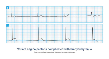 A 76-year-old man presented with syncope during an episode of variant angina pectoris. The electrocardiogram showed sinus arrest or third-degree sinoatrial block with junctional escape rhythm.