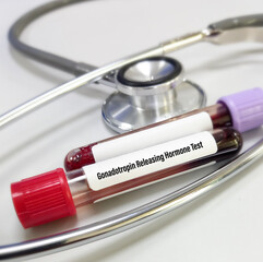 Gonadotropin releasing hormone (GnRH). Test tube with blood sample for Gonadotropin releasing hormone (GnRH) test. Stethoscope.