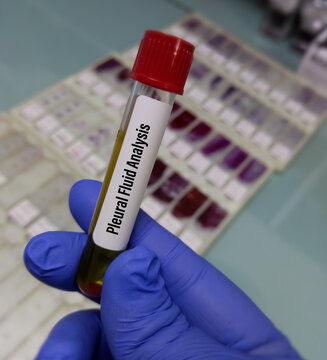 Biochemist or medical technologist hold Pleural fluid analysis sample, Pleural effusion.