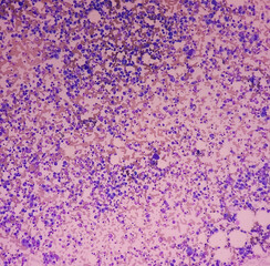 Microscopic image of bone marrow. Plasma cell dyscrasia or Multiple myeloma. A type of bone marrow cancer of malignant plasma cells. - obrazy, fototapety, plakaty