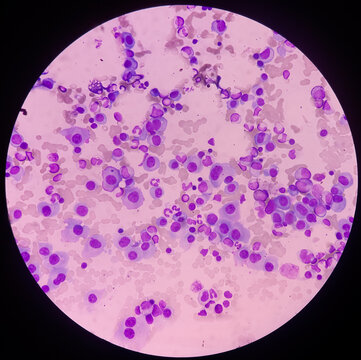 Microscopic Image Of Bone Marrow. Plasma Cell Dyscrasia Or Multiple Myeloma. A Type Of Bone Marrow Cancer Of Malignant Plasma Cells.