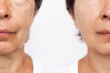 Lower part of face and neck of elderly woman with signs of skin aging before after facelift,...