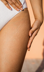 Stretch marks on female legs. A woman's hand holds a fat cellulite and a stretch mark on her leg. Cellulite close-up.