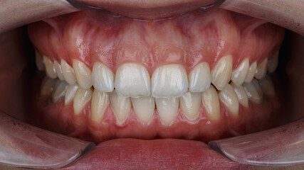 upper jaw with gum for resection for a perfect smile - obrazy, fototapety, plakaty