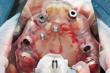 dental photo through the mirror surgical template for total implantation