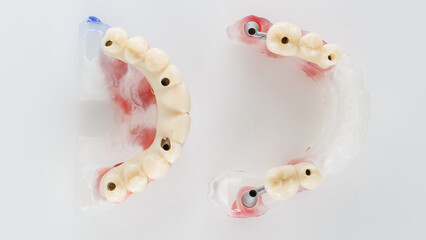 top view of a dental model with temporary resin dentures on a white background