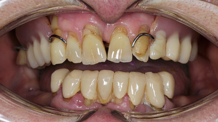 upper jaw of a patient with poor and cheap bridges and missing teeth in the lower jaw © Dental Pro Content