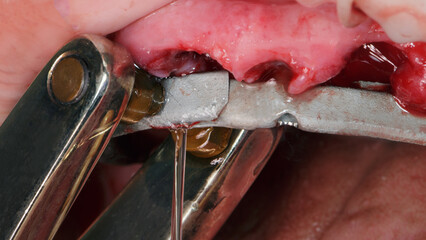 dental moment of intraoral verification of the beam
