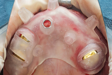 dental template for the entire jaw for the installation of one implant