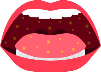 mouth disease. enteroviruses name of virus. be careful of your chidren and yourself