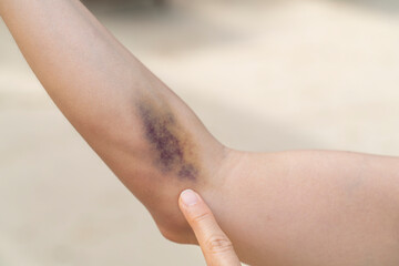 A bruise on forearm with the color of blue and purple is a hematoma of tissue with the background of blurred sand. - obrazy, fototapety, plakaty