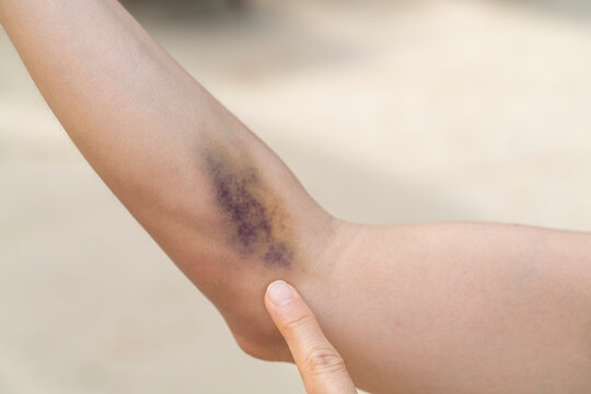 A bruise on forearm with the color of blue and purple is a hematoma of tissue with the background of blurred sand.