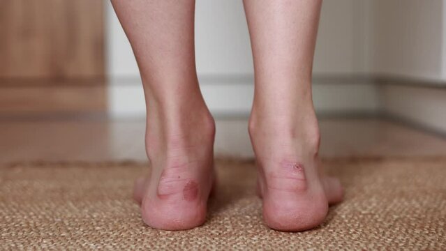 woman scratches her foot with calluses blisters. Painful wounds. Uncomfortable shoes problems. View of foot with inflammatory corns. Health and beauty concept