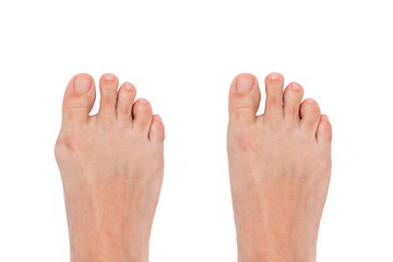 Hallux valgus deformity of the big toe caused by wearing uncomfortable shoes. A woman's  foot before and after treatment  isolated on a white background. Orthodontics  - obrazy, fototapety, plakaty