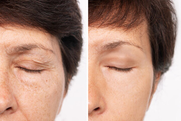 Elderly caucasian woman's face with puffiness under her eyes and wrinkles on eyelids before and after blepharoplasty. Age-related skin changes,fatigue. Result of plastic surgery. Rejuvenation - obrazy, fototapety, plakaty